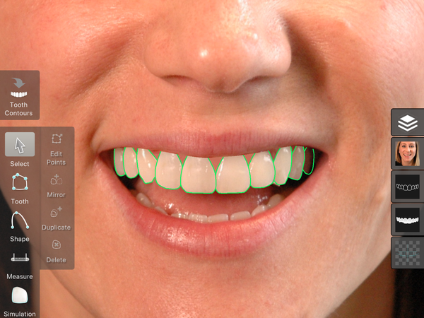 Smile Designer Pro with the proposed tooth contours drawn over a patient's smile