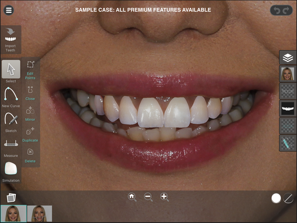The simulated outcome rendered over the patient's own smile