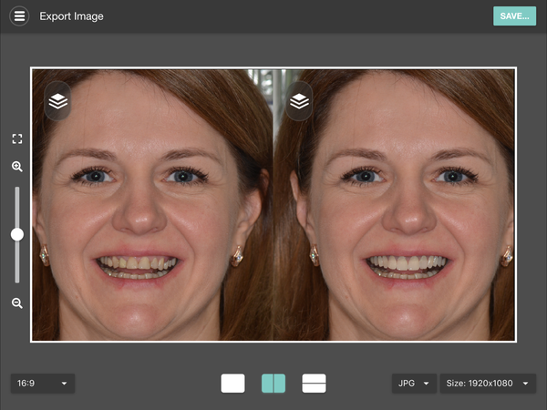 Export view with the before and after side by side, ready to show the patient