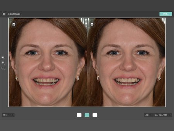 Before and after of a treatment, exported at 16:9